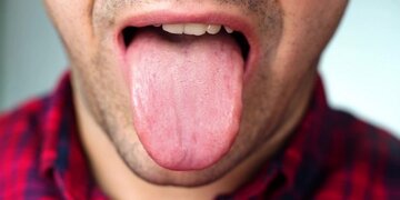 رنگ زبان نشان دهنده چه بیماری‌هایی است؟